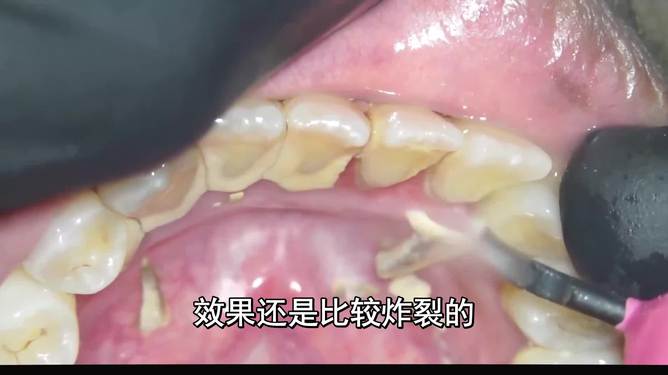 最新去牙垢科普指南，實(shí)用方法與建議