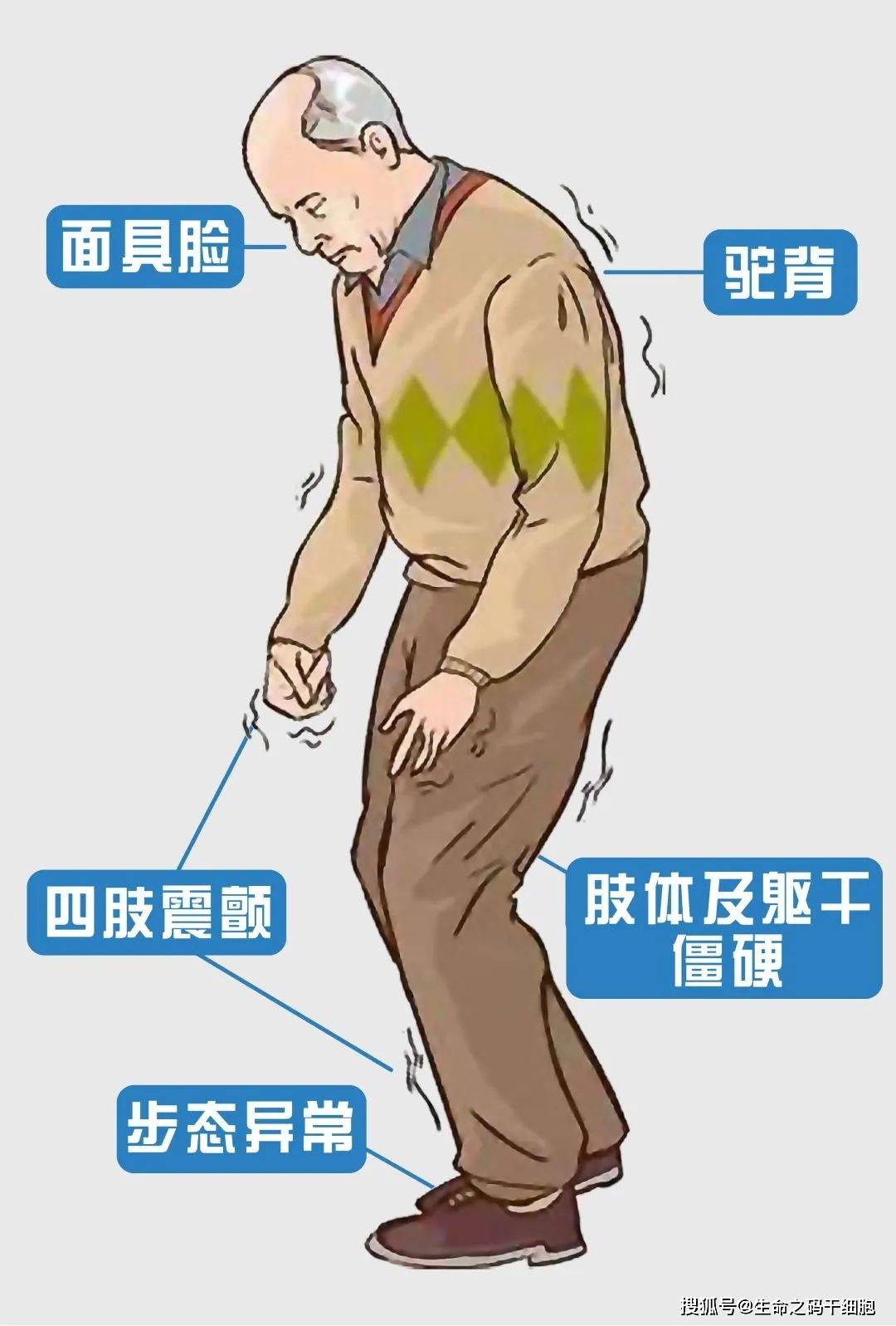 干細胞帕金森最新動態(tài)，小巷神秘小店引領醫(yī)學新時代！